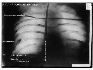 Roosevelt's X-ray with bullet